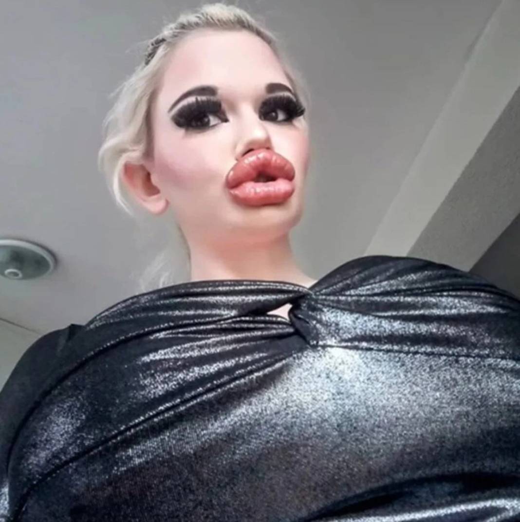 Dudak estetiğine harcadığı para 'dudak' uçuklattı 3